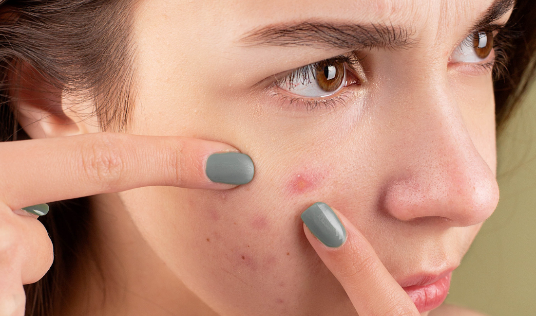 Skin Purging vs. Skin Breakouts How To Tell The Difference Blue